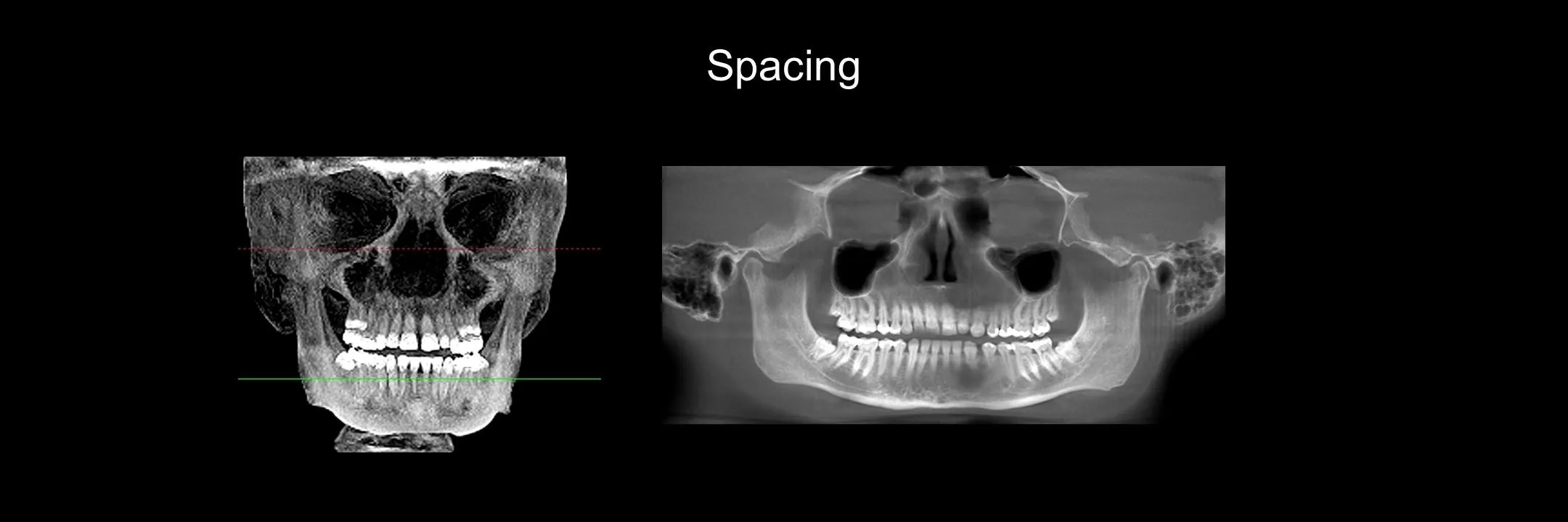 Before and After Minimally Prepared Veneers photo 2