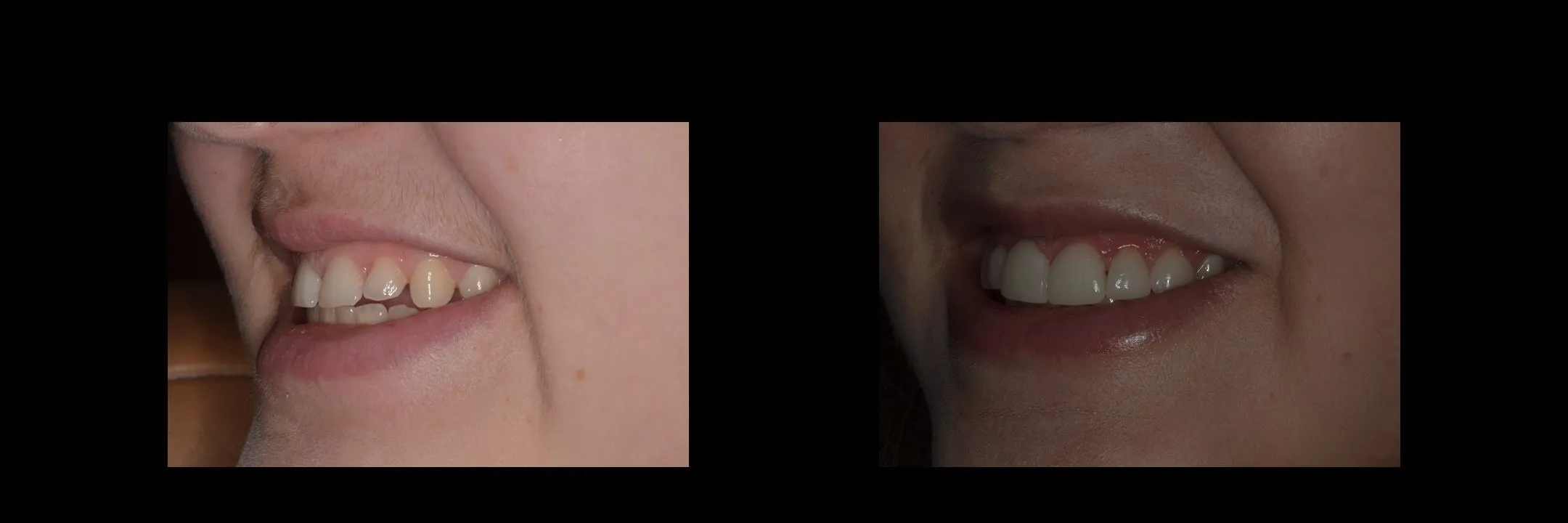 Before and After Minimally Prepared Veneers photo 5