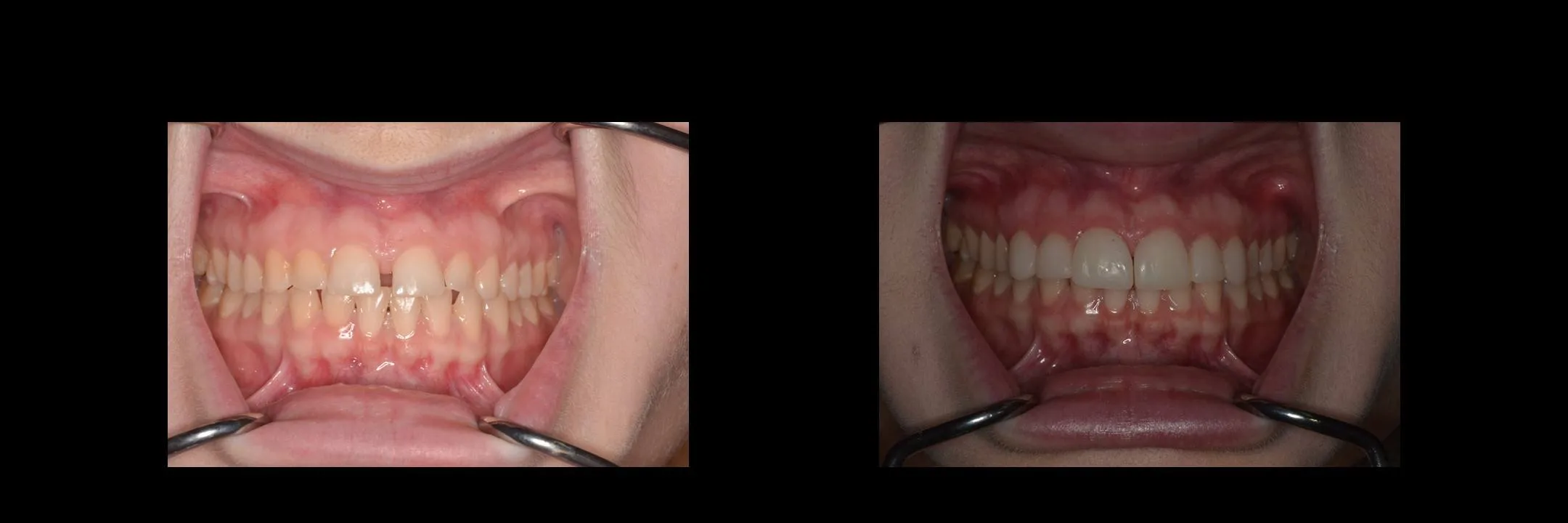 Before and After Minimally Prepared Veneers photo 6