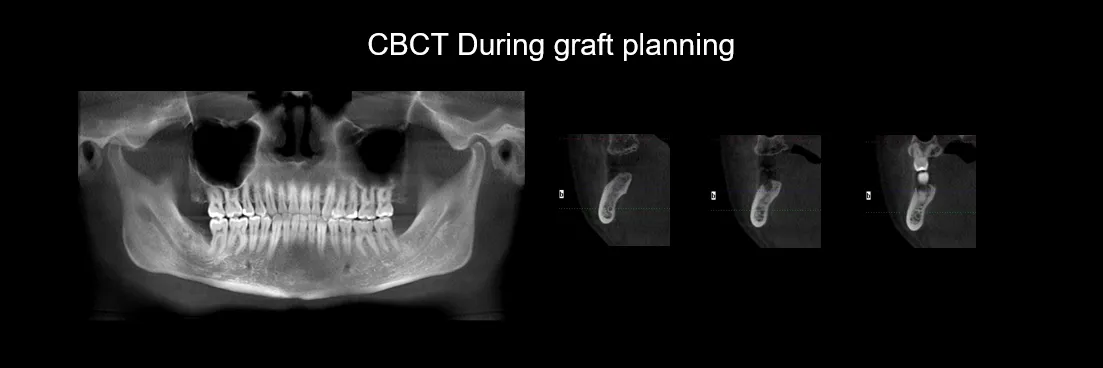 Before and After Bone Graft photo 2