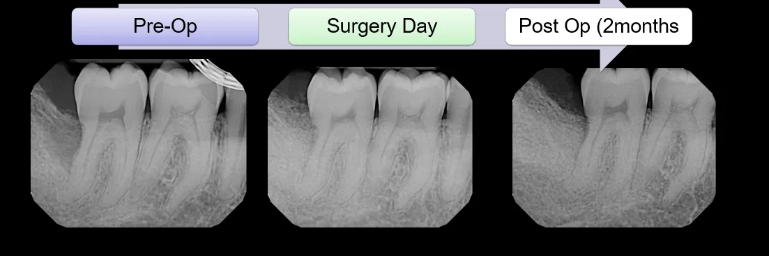 Before and After Bone Graft photo 3