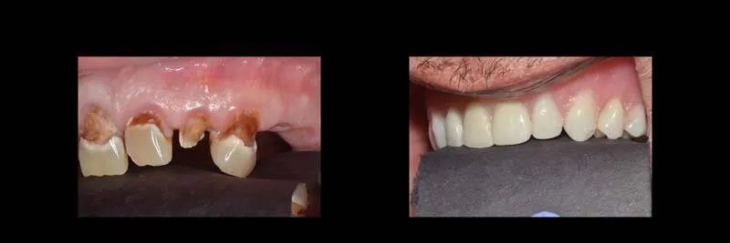 Before and After Full-Mouth Rehabilitation photo 11