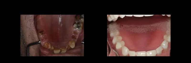 Before and After Full-Mouth Rehabilitation photo 12