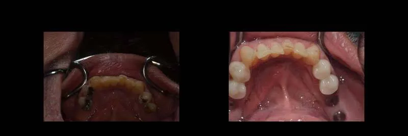 Before and After Full-Mouth Rehabilitation photo 13