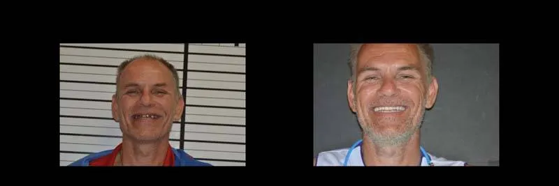 Before and After Full-Mouth Rehabilitation photo 15