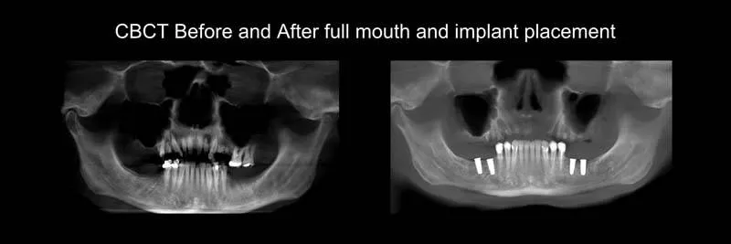 Before and After Full-Mouth Rehabilitation photo 2
