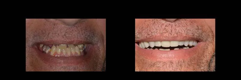 Before and After Full-Mouth Rehabilitation photo 3