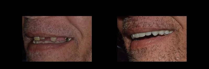Before and After Full-Mouth Rehabilitation photo 5