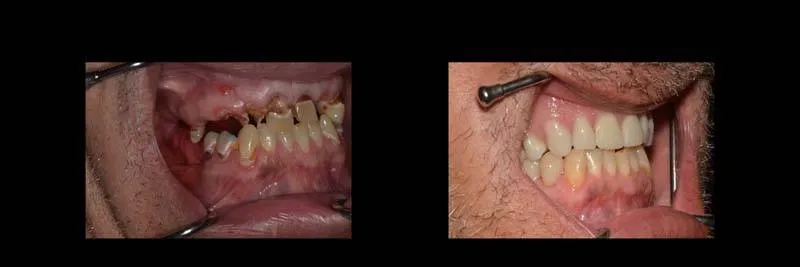 Before and After Full-Mouth Rehabilitation photo 7