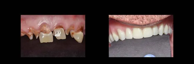 Before and After Full-Mouth Rehabilitation photo 9