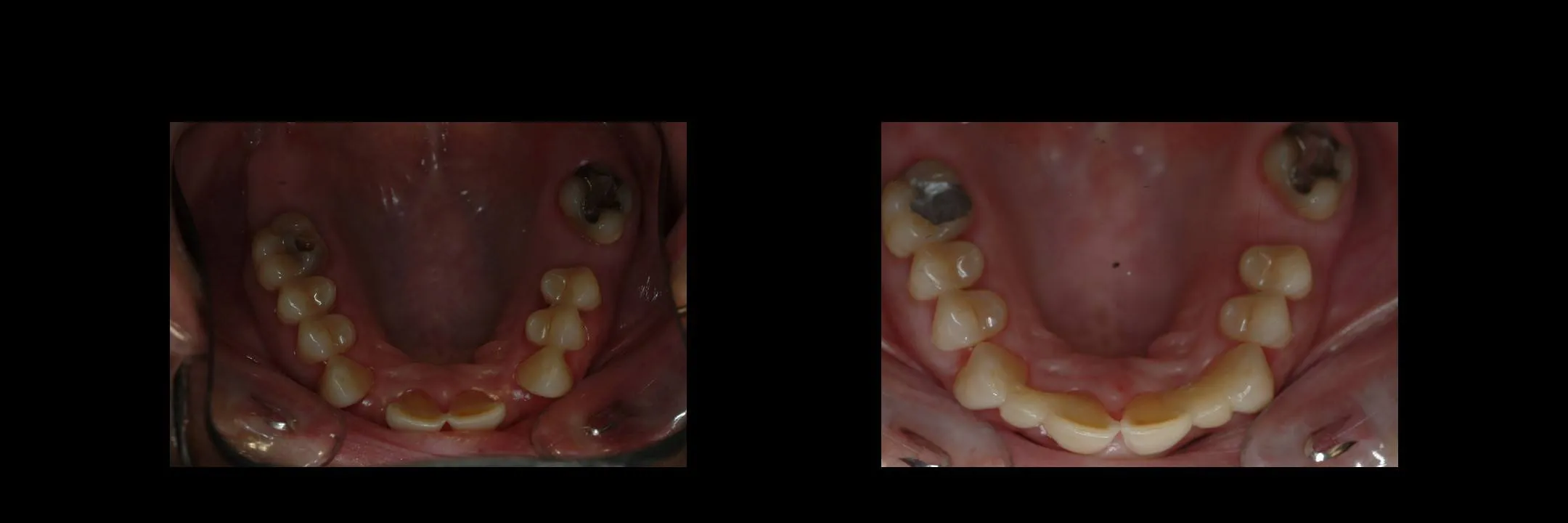 Before and After Provisional/Temporary Bridges photo 11