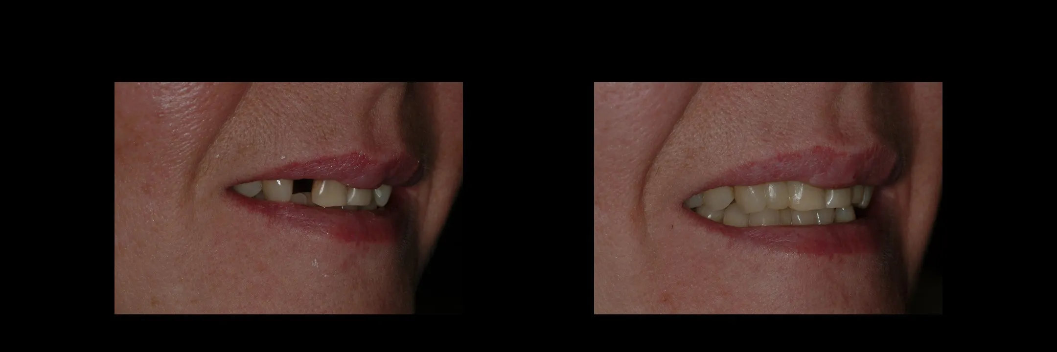 Before and After Provisional/Temporary Bridges photo 3