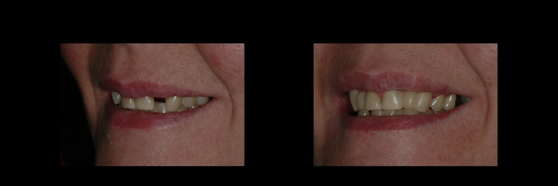 Before and After Provisional/Temporary Bridges photo 4