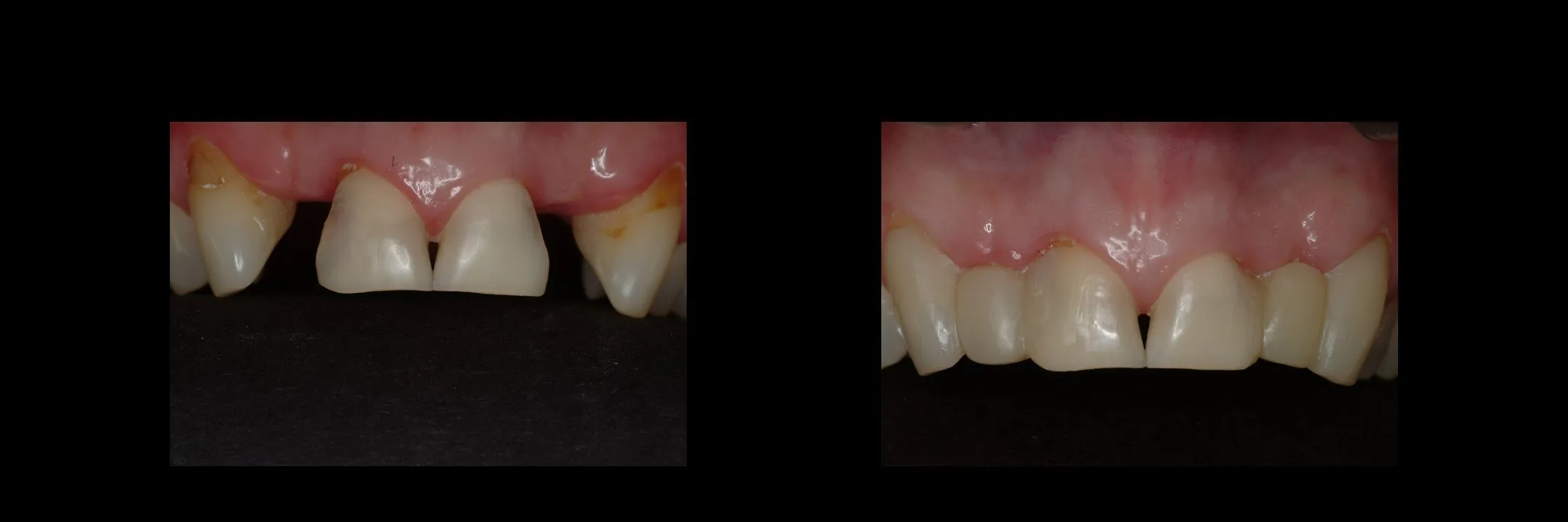 Before and After Provisional/Temporary Bridges photo 8