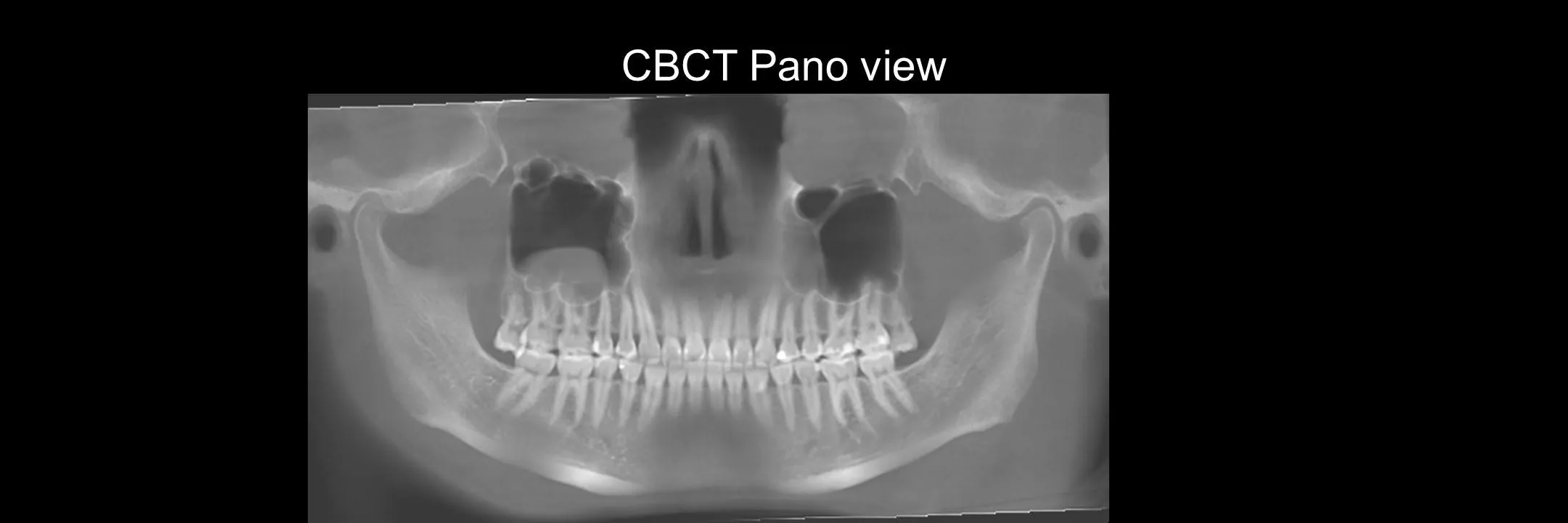 Before and After Excisional Biopsy photo 2