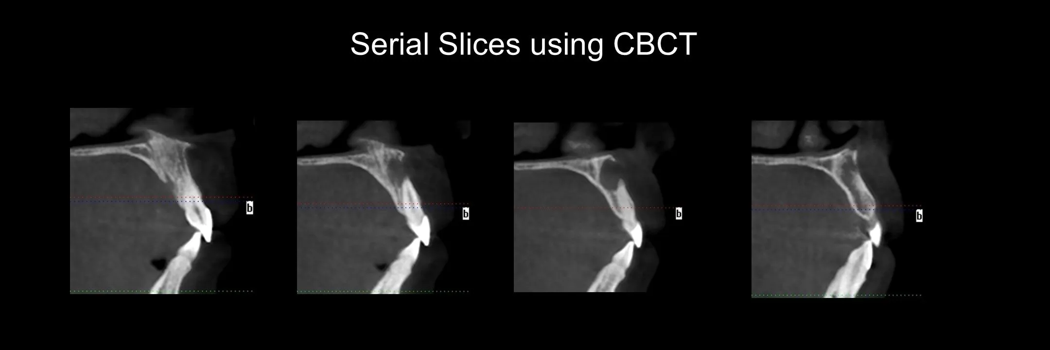 Before and After Excisional Biopsy photo 3