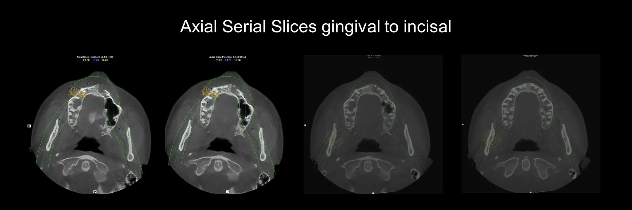 Before and After Excisional Biopsy photo 4