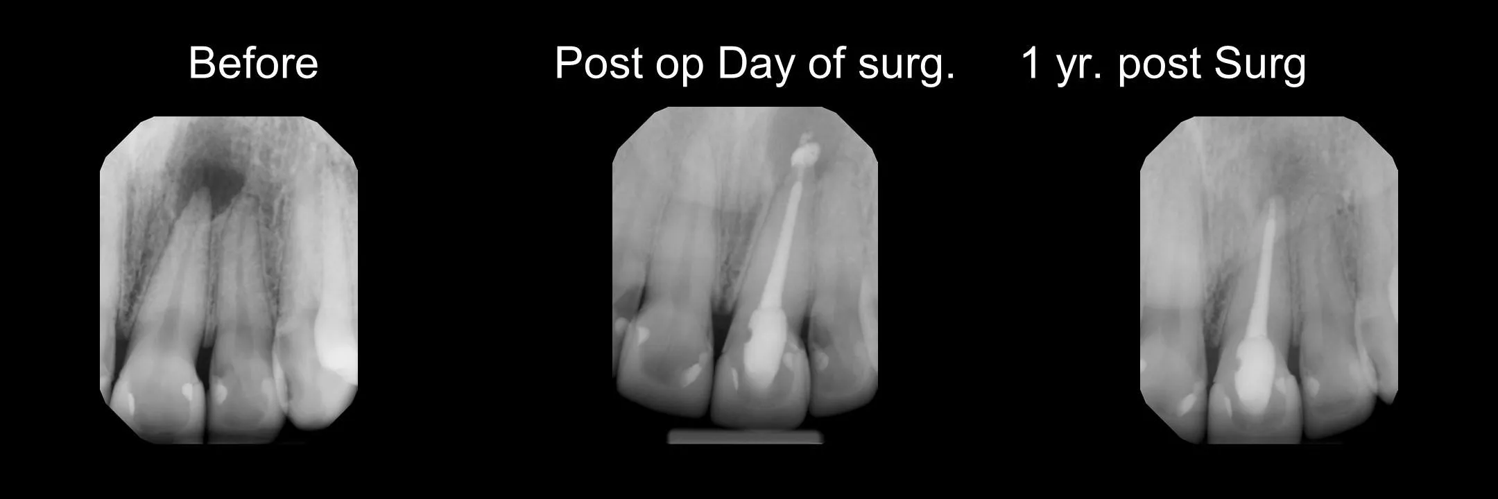 Before and After Excisional Biopsy photo 5