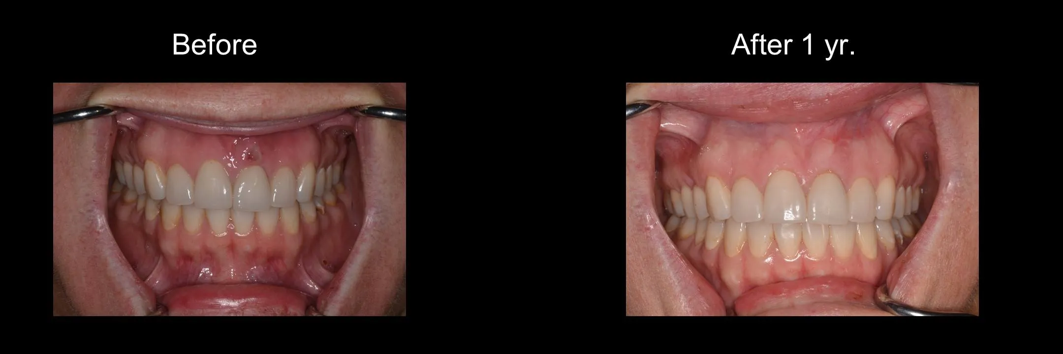 Before and After Excisional Biopsy photo 7