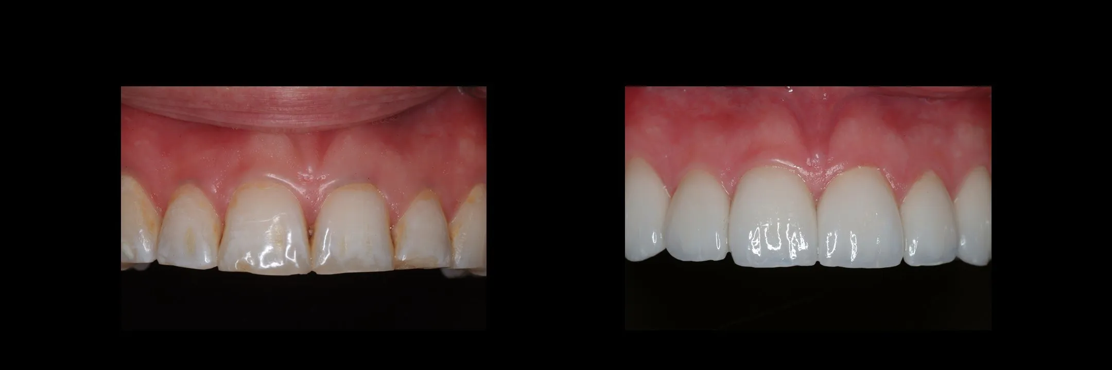 Before and After Porcelain Veneers photo 12