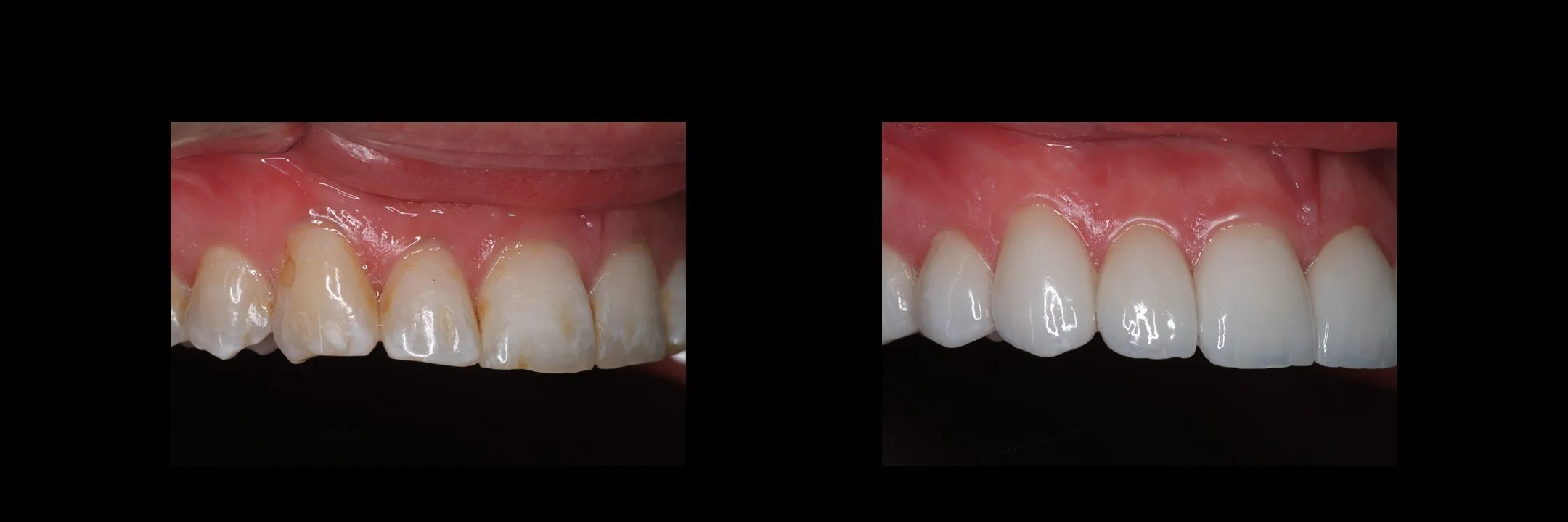 Before and After Porcelain Veneers photo 13