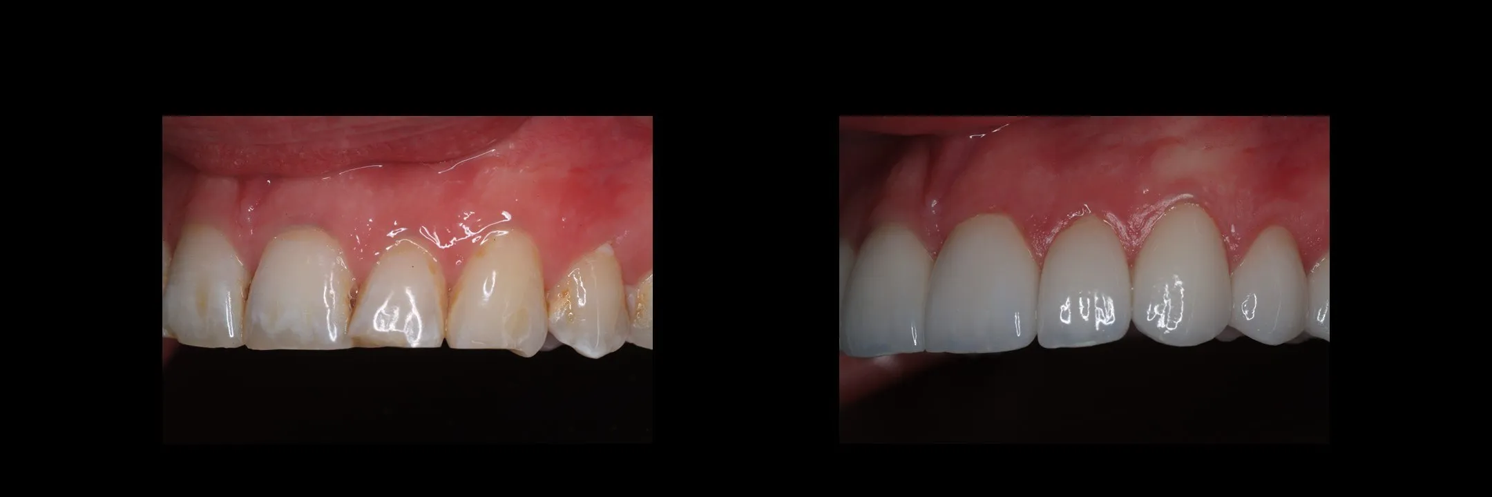 Before and After Porcelain Veneers photo 14