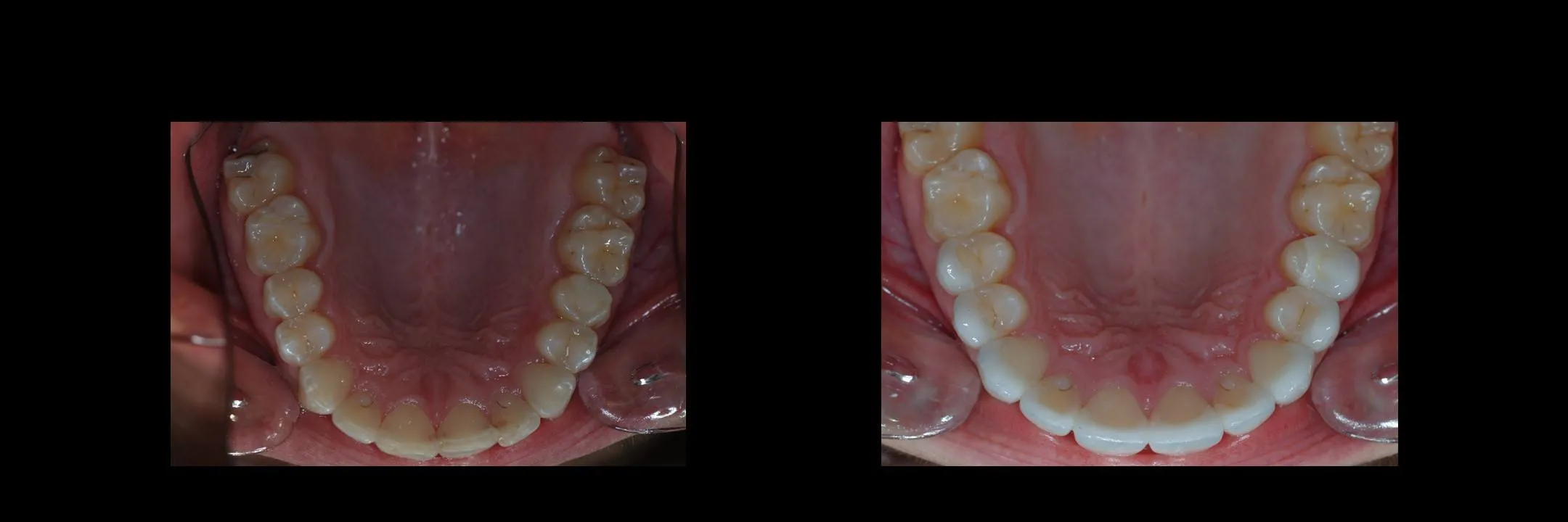 Before and After Porcelain Veneers photo 15