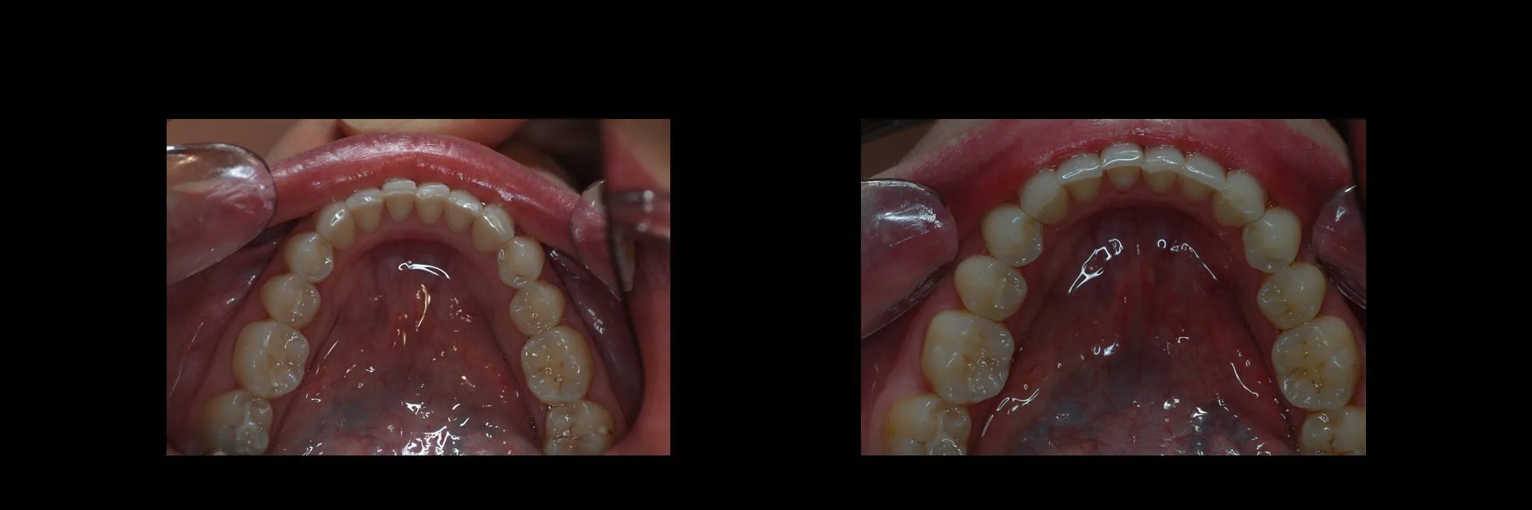 Before and After Porcelain Veneers photo 16
