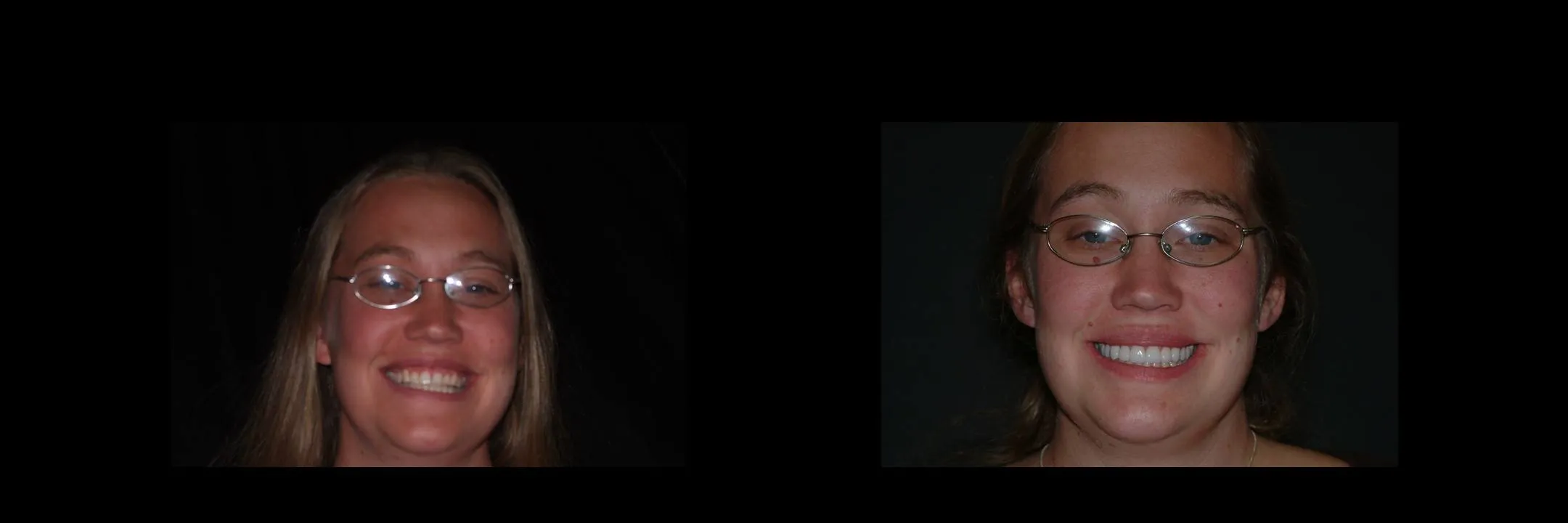 Before and After Porcelain Veneers photo 2