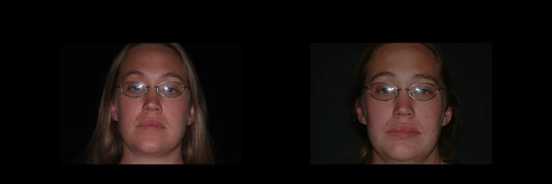 Before and After Porcelain Veneers photo 3