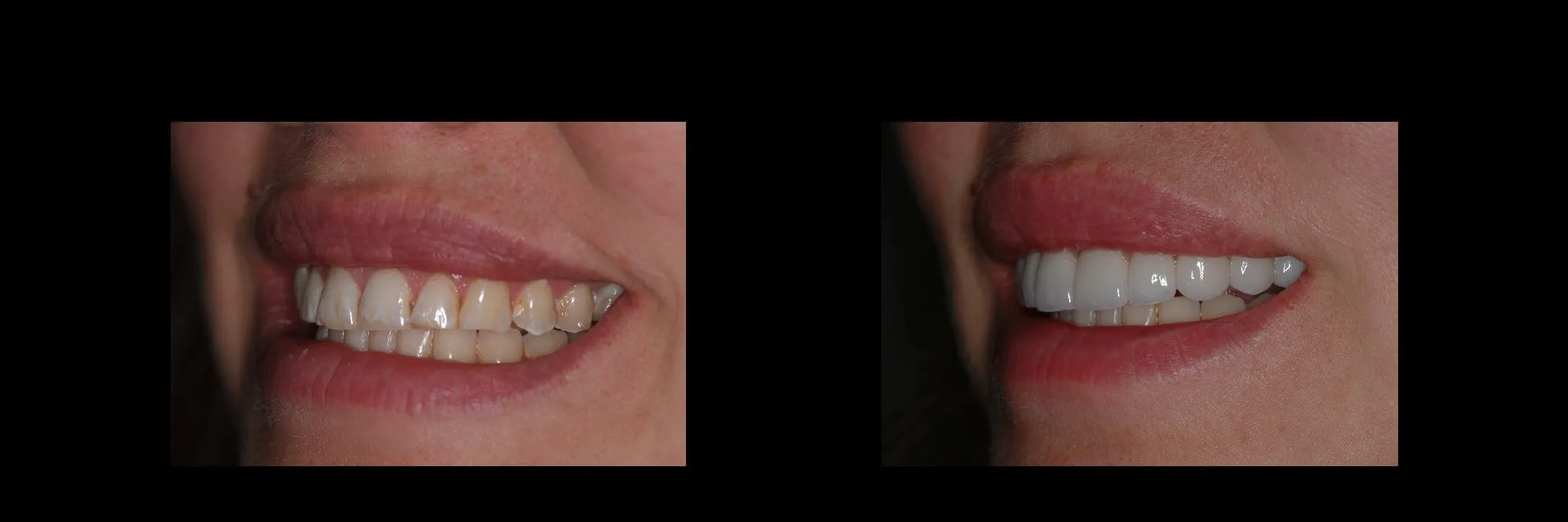 Before and After Porcelain Veneers photo 7