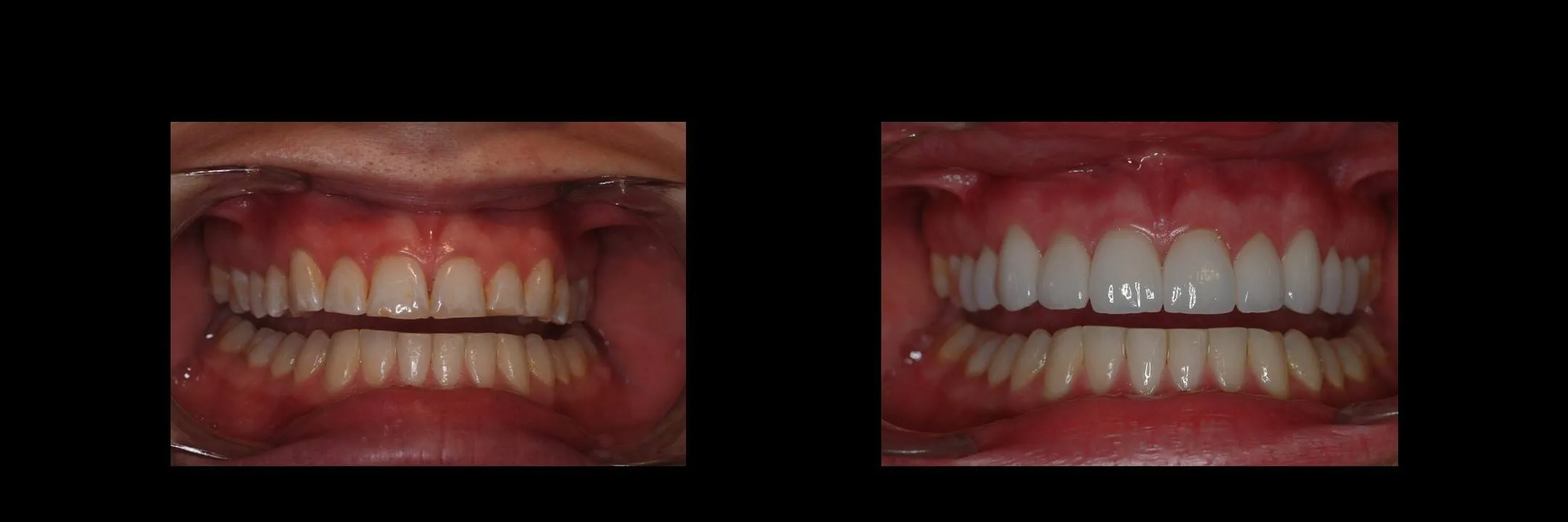 Before and After Porcelain Veneers photo 9