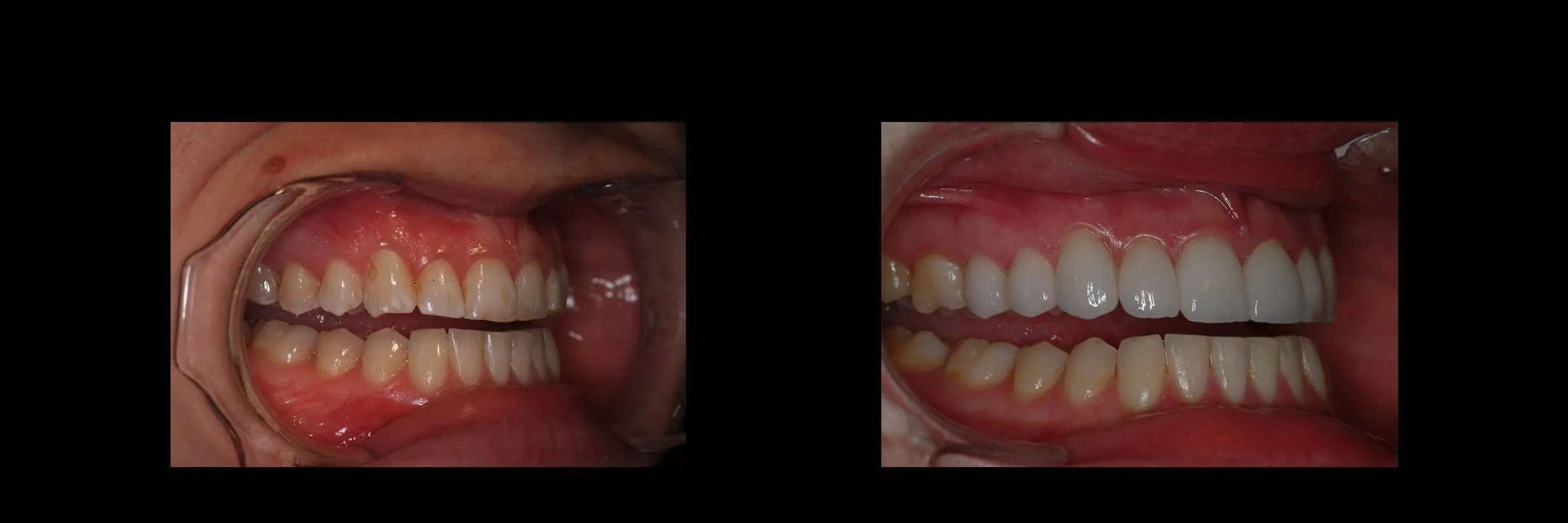 Before and After Porcelain Veneers photo 10