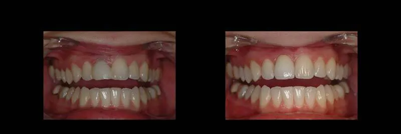 Before and After Single-Implant Restoration photo 10