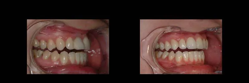 Before and After Single-Implant Restoration photo 11