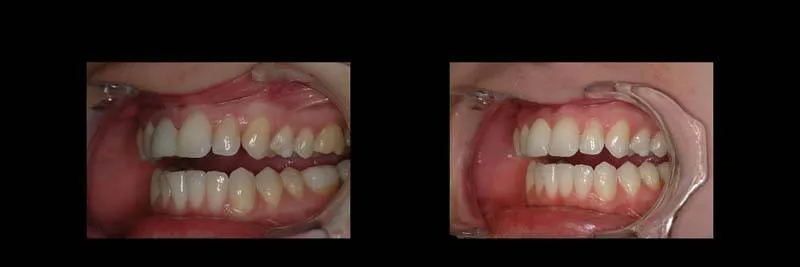 Before and After Single-Implant Restoration photo 12
