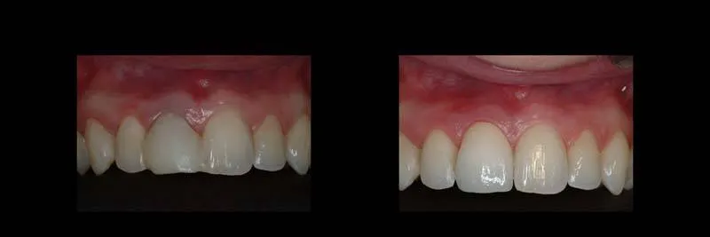 Before and After Single-Implant Restoration photo 13
