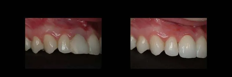 Before and After Single-Implant Restoration photo 14