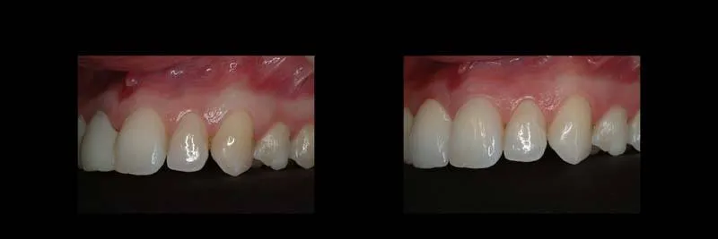 Before and After Single-Implant Restoration photo 15