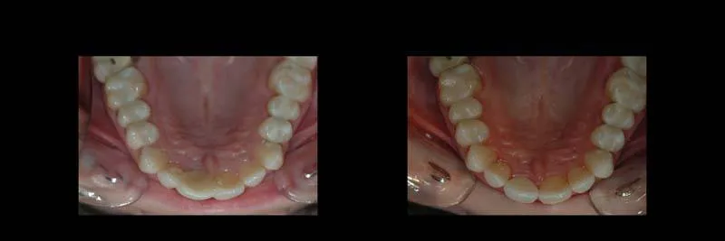 Before and After Single-Implant Restoration photo 16