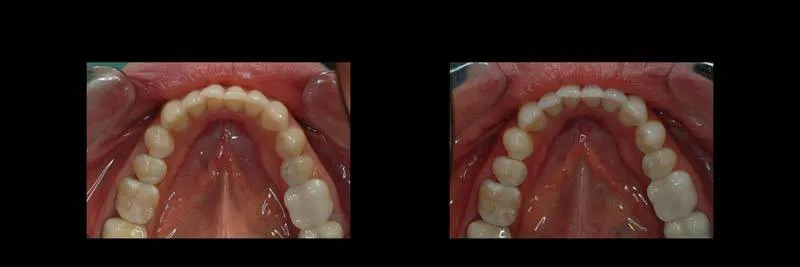 Before and After Single-Implant Restoration photo 17