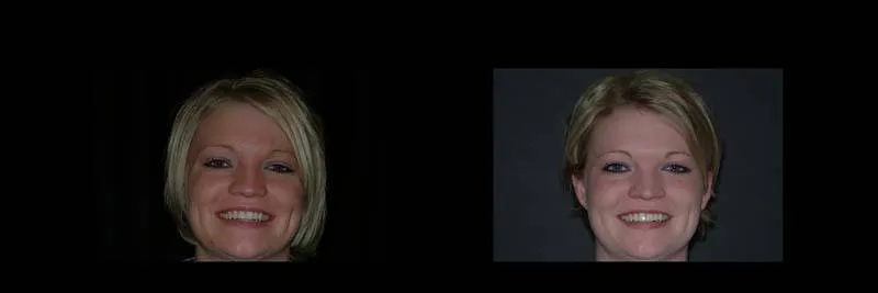 Before and After Single-Implant Restoration photo 4