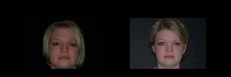 Before and After Single-Implant Restoration photo 5