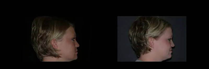 Before and After Single-Implant Restoration photo 6