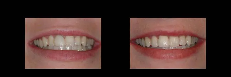 Before and After Single-Implant Restoration photo 7