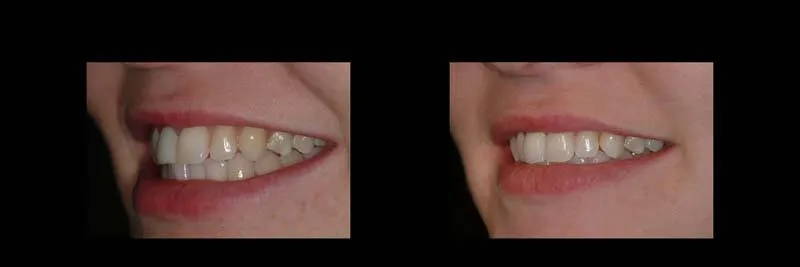 Before and After Single-Implant Restoration photo 9