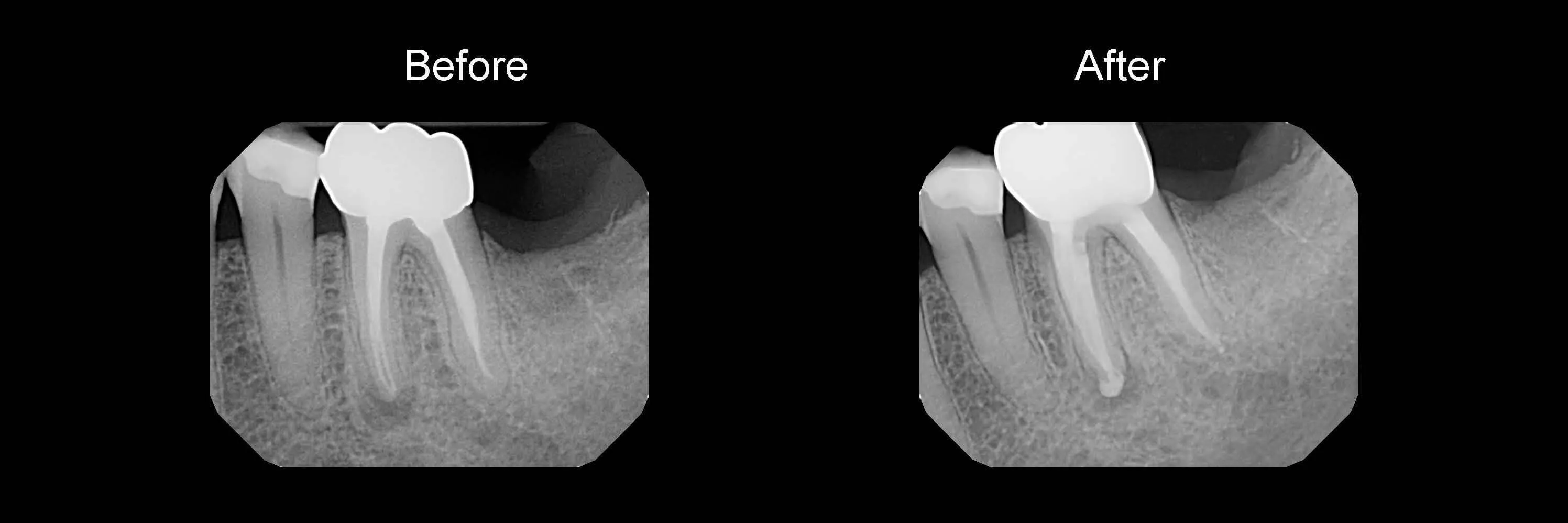 Before and After Safe Root Canals Using Sonendo photo 2