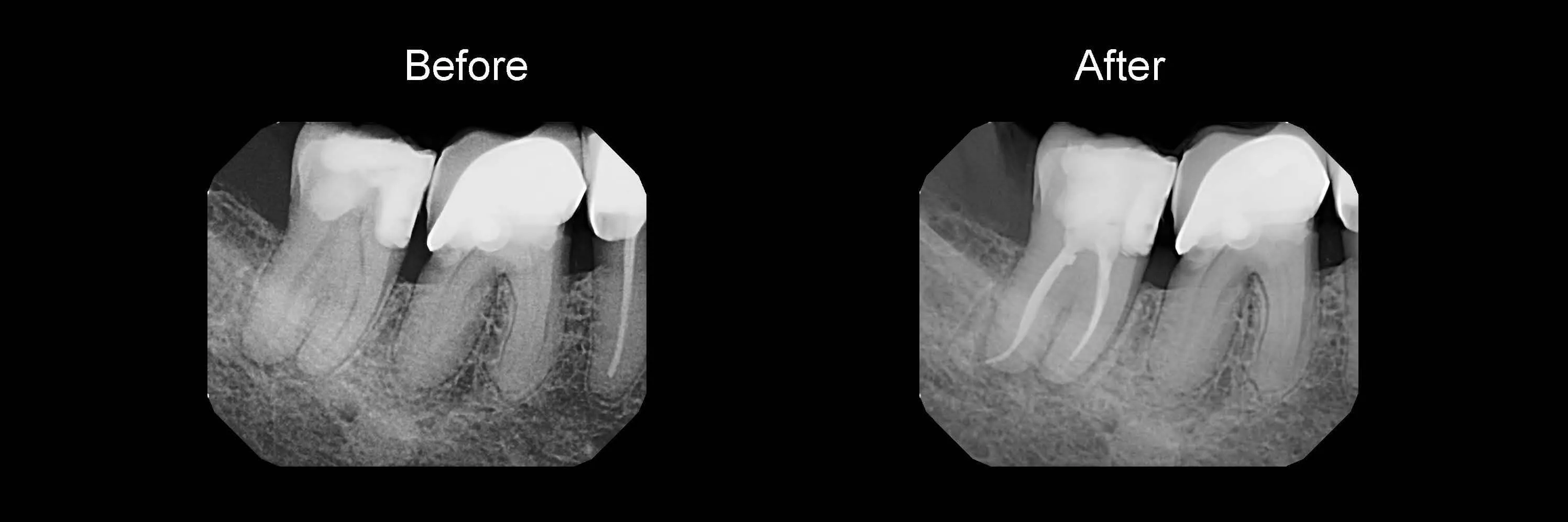 Before and After Safe Root Canals Using Sonendo photo 3