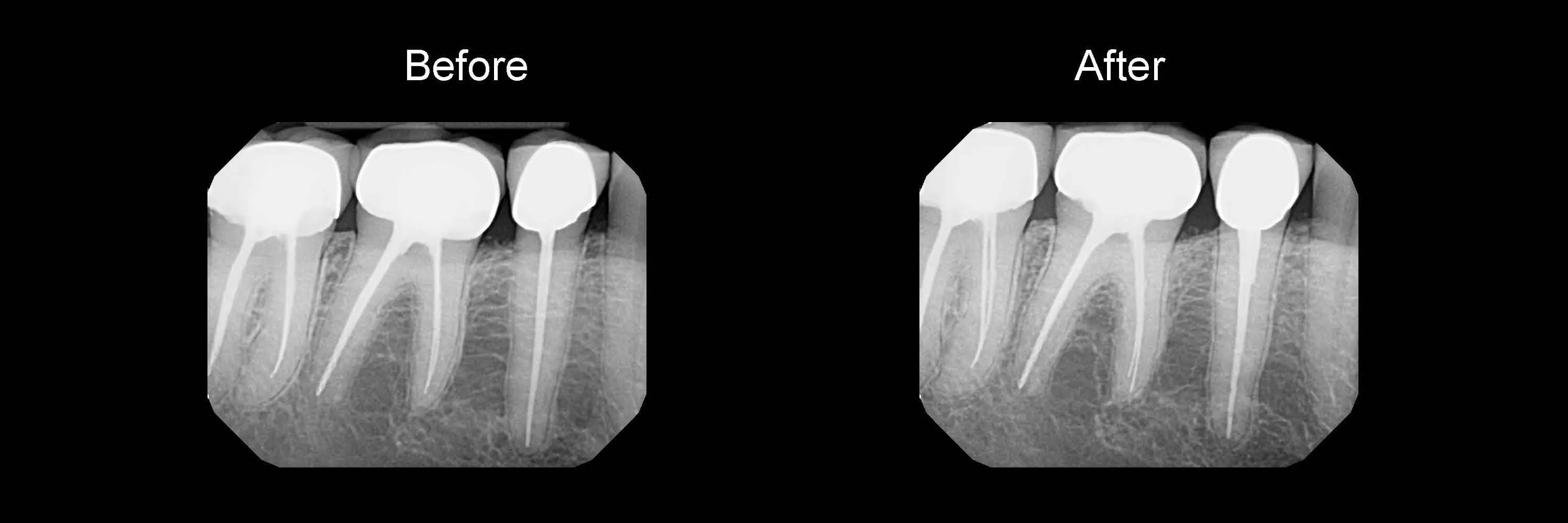Before and After Safe Root Canals Using Sonendo photo 4