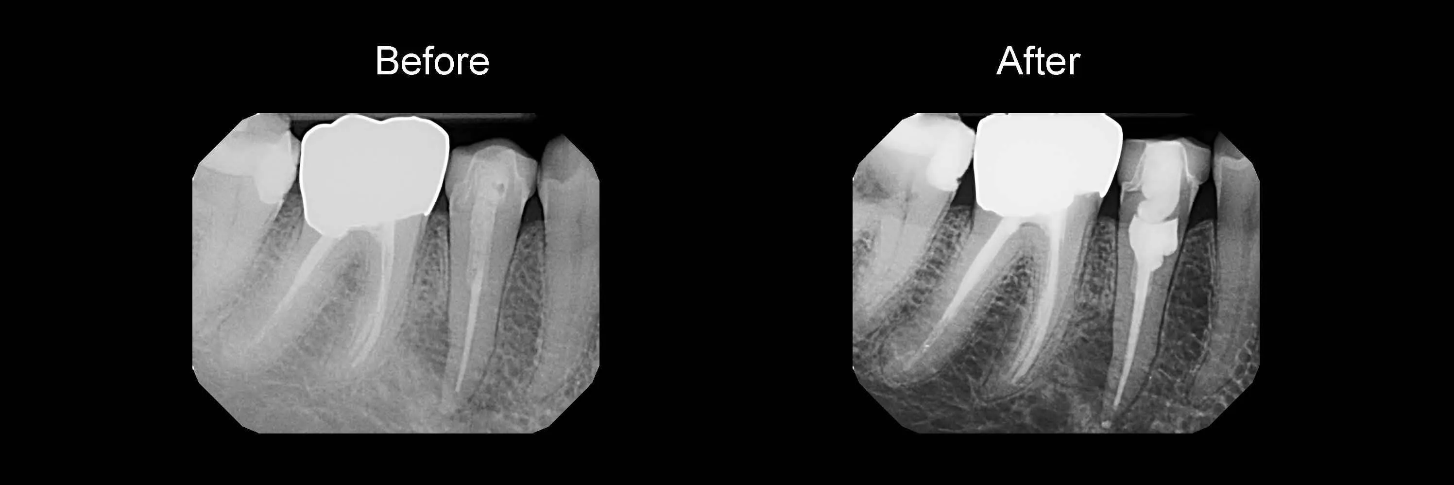 Before and After Safe Root Canals Using Sonendo photo 5